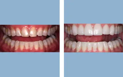 Before and After